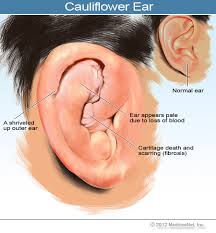Treatment of Traumatic Ear Deformities