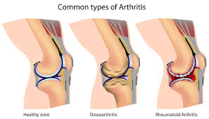 Treatment Arthritis Naturally