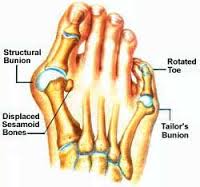 How to Treatment of Bunions