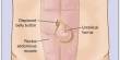 Causes of Umbilical Hernia