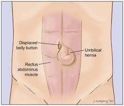 Causes of Umbilical Hernia