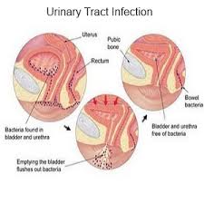 Causes and Symptoms of Urinary Tract Infection