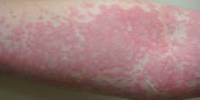 Natural Treatment for Urticaria