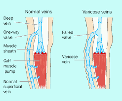 Analysis on Venous Leg Ulcers