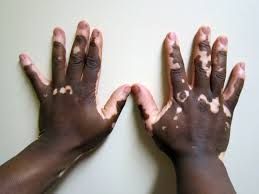 Reasons for Vitiligo