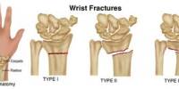 Overview Common Wrist Fractures