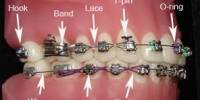 Define on Different Types of Braces