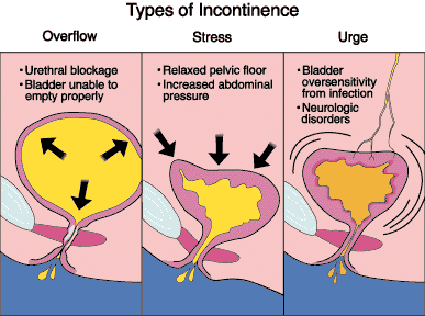 Define on Female Incontinence