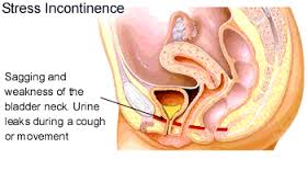 Discuss on Female Incontinence