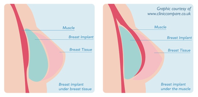 The Potential Benefits Of Breast Uplift Surgery