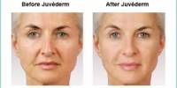 Revitalizing Effects of Juvederm