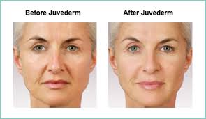 Revitalizing Effects of Juvederm