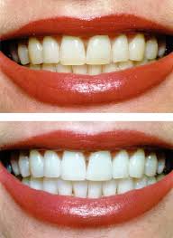 Discuss on Teeth Whitening and Secrets