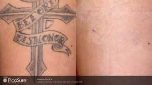 Analysis on Cosmetic Surgical Tattoo
