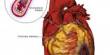 Types of Heart Disease and Treatment