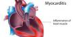 Signs and Symptoms of Myocarditis