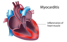 Signs and Symptoms of Myocarditis