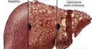 About Alcoholic Liver Disease
