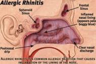 About Allergic Rhinitis