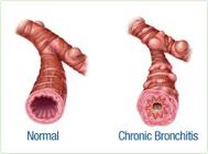 Risk in Chronic Bronchitis