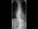 About Congenital Scoliosis