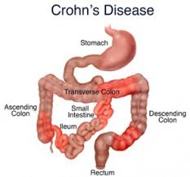 Diagnosing Crohns Disease