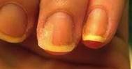 Fingernail Discoloration