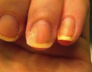 Fingernail Discoloration