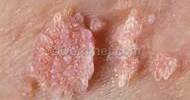 About Genital Warts
