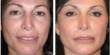 Laser Facial Resurfacing