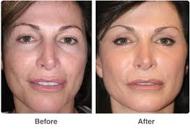 Laser Facial Resurfacing