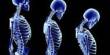 Define on Osteoporosis