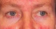 Main Forms of Rosacea