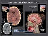 Subarachnoid Hemorrhage