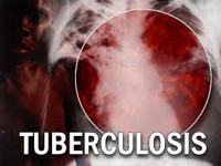 About Tuberculosis