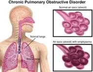 About Chronic Obstructive Pulmonary Disease
