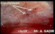 Endometriosis and Interstitial Cystitis