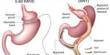 About Gastric Bypass Surgery