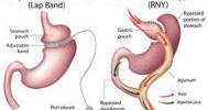 About Gastric Bypass Surgery