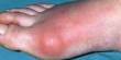 Reasons of Gout