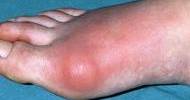 Reasons of Gout