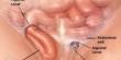 About Inguinal Hernia