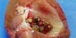 Know about Kidney Stones