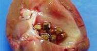 Know about Kidney Stones