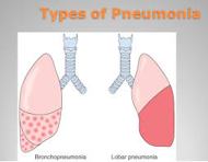 Various Kinds of Pneumonia