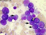 Promyelocytic Leukemia