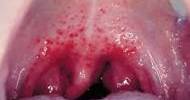 Strep Throat Symptoms