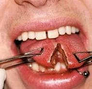 Danger of Tongue Piercing