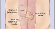 About Umbilical Hernia