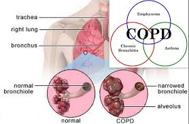 Know About Chronic Obstructive Pulmonary Disease